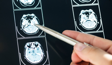 Tumores del cerebro y otros tumores del sistema nervioso central