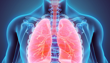 Carcinoma broncogenico