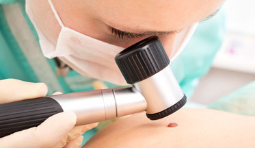 Melanoma